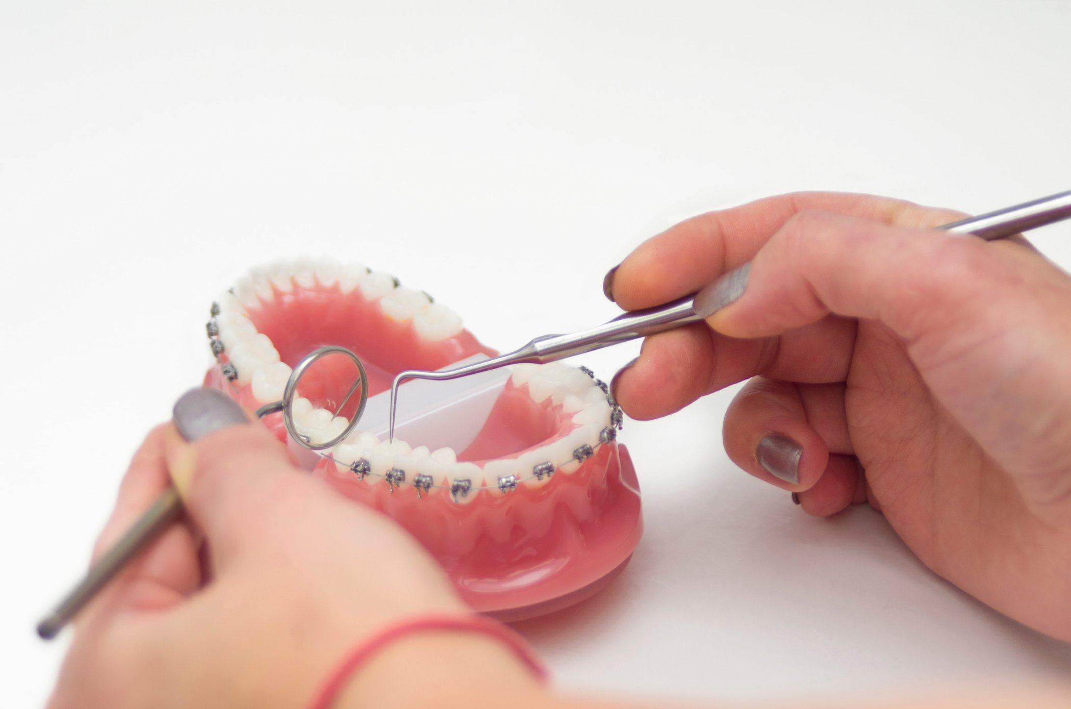 Ventajas y desventajas de los brackets de autoligado